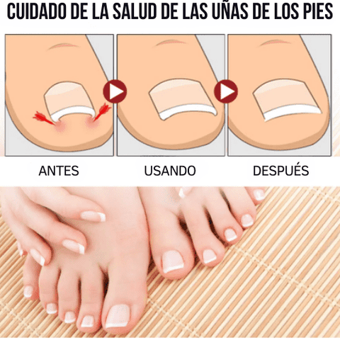 SUERO PARA HONGO DE LAS UÑAS ®